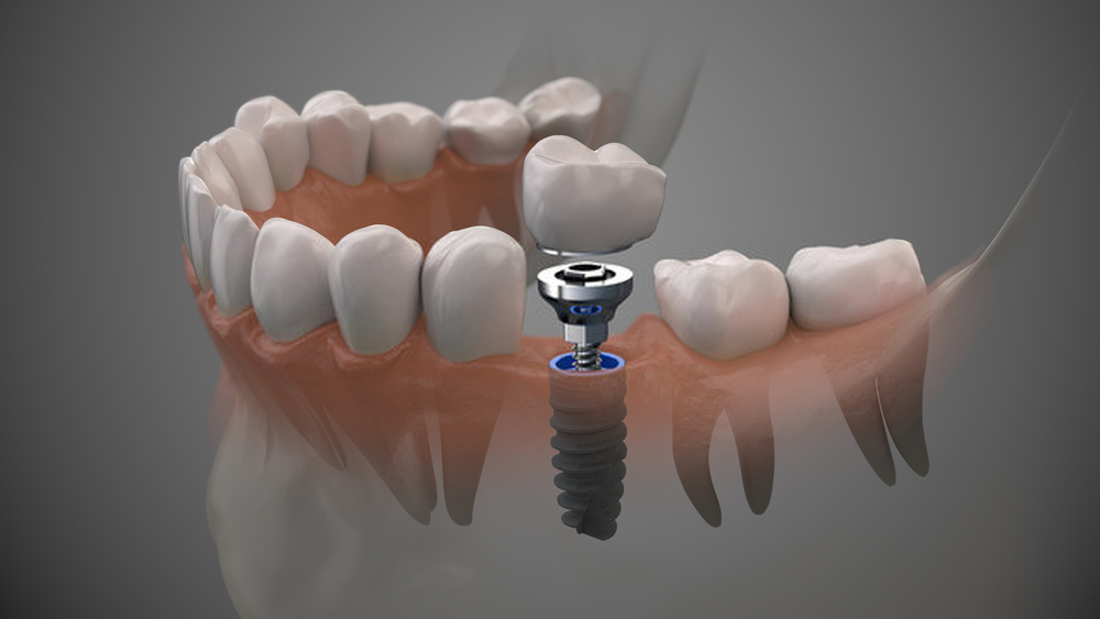 implants for dentures